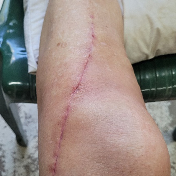 Therapy 3 Before